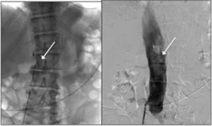 Medico esegue una radiografia toracica per escludere neoplasie occulte in pazienti con TVP.
