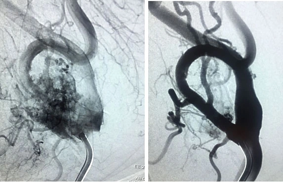 Asportazione Chirurgica del Tumore del Glomo Carotideo Intervento chirurgico per la rimozione di un tumore del glomo carotideo.