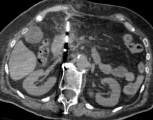 Terapie ablative minimamente invasive per il trattamento del cancro del pancreas