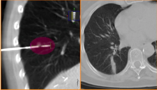 Carcinoma polmonare a piccole cellule: forma aggressiva e metastatica del tumore del polmone