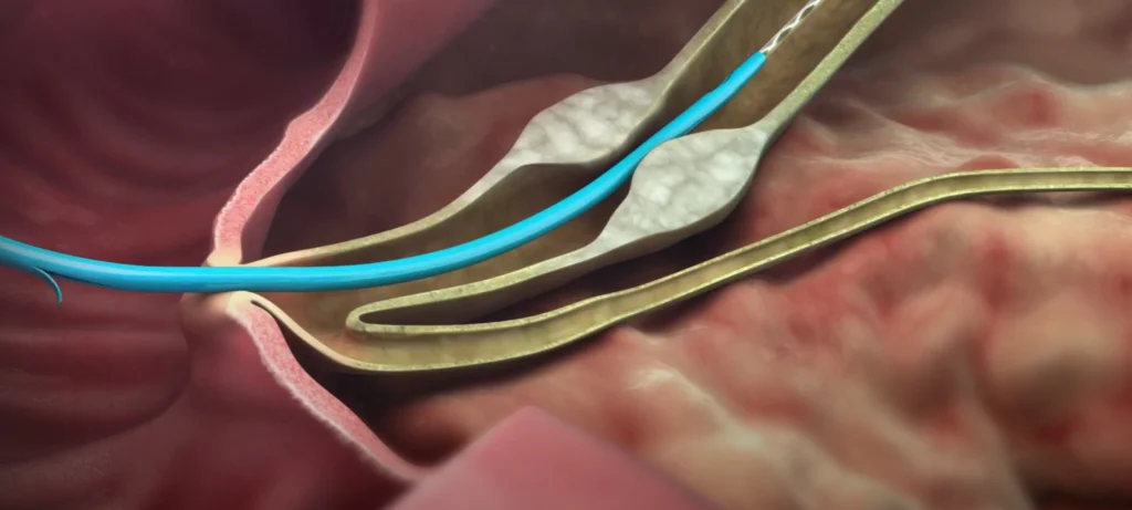 Immagine che illustra il trattamento della stenosi biliare benigna con radiologia interventistica.