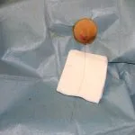 Posizionamento percutaneo di marker sotto guida ecografica Radiologo interventista posiziona un marker sotto guida ecografica per un intervento chirurgico mirato.