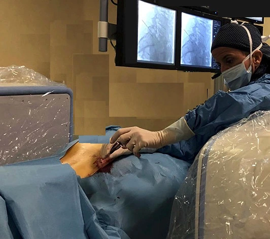 Trattamento percutaneo dell'ernia al disco con tecnologia avanzata