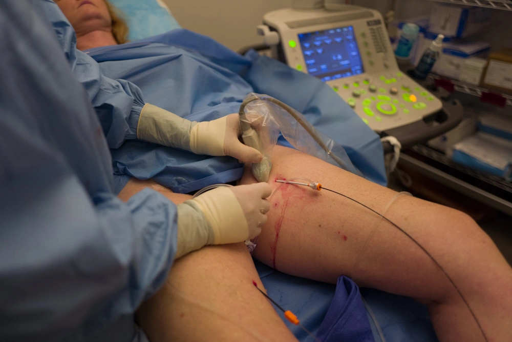 Ablazione della vena safena con radiofrequenza per il trattamento delle vene varicose.