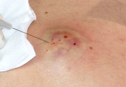 Drenaggio ascesso eseguito mediante guida radiologica interventistica