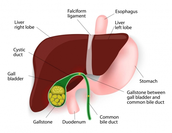 Calcoli biliari visibili su un'ecografia delle vie biliari, evidenziando l'ostruzione della colecisti.