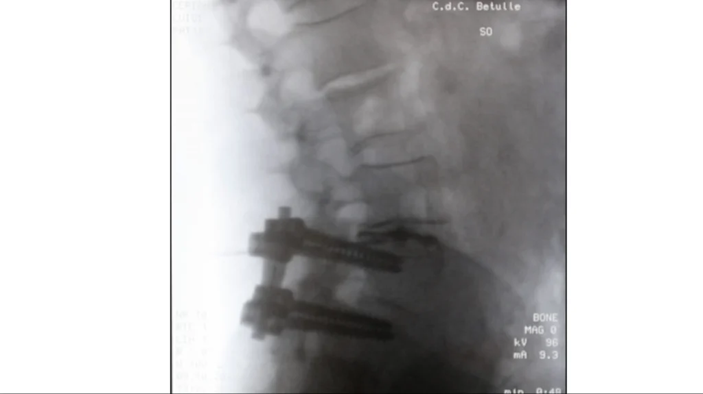 Monitoraggio post-operatorio della discectomia Monitoraggio del paziente dopo la discectomia percutanea meccanica.