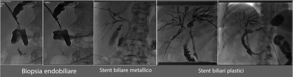 Trattamenti di radiologia interventistica per i tumori delle vie biliari Biopsia endobiliare, stent biliare metallico, stent biliari plastici e sala operatoria della radiologia interventistica.