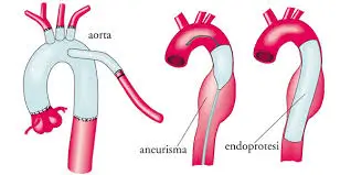 Dissezione aortica trattata con tecniche di radiologia interventistica minimamente invasive
