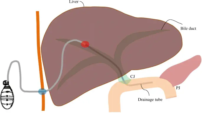Immagine che mostra una procedura di drenaggio percutaneo della colecisti per il trattamento della colecistite acuta.