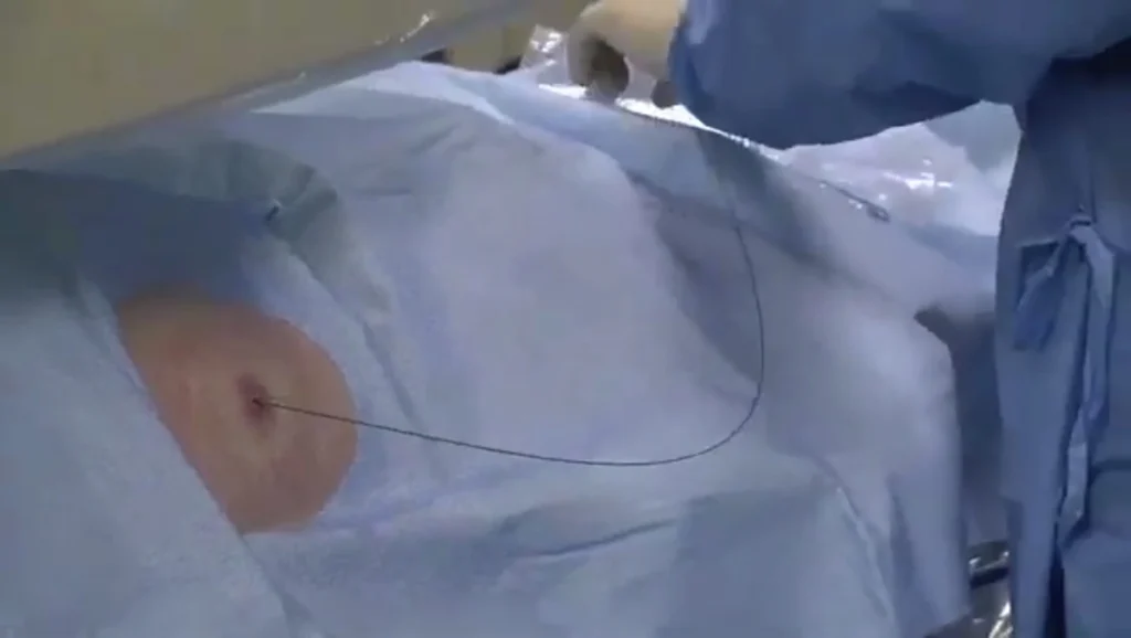 Posizionamento di un drenaggio biliare sotto guida radiologica per trattare l'ostruzione delle vie biliari.