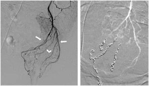 Arteriografia dell'arteria rettale superiore con evidenza delle diramazioni trattate mediante embolizzazione per il trattamento mininvasivo delle emorroidi.