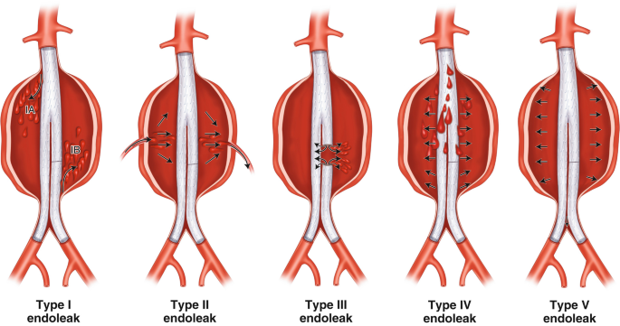 Trattamento endoleak tipo II mediante embolizzazione delle arterie afferenti