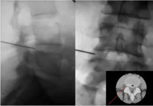 Ernia al disco trattata con tecnica percutanea avanzata