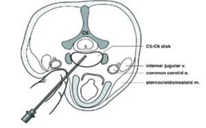 Iniezione di steroidi per ernia al disco con radiologia interventistica