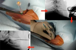 Radiologia interventistica per trattamento ernia al disco minimamente invasivo