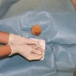 Localizzazione pre-operatoria di noduli mammari con marker Posizionamento percutaneo di un marker in un nodulo mammario sotto guida radiologica.