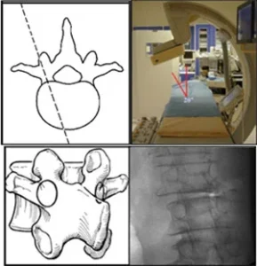 Immagini radiologiche di frattura ossea diagnosticate tramite radiologia interventistica