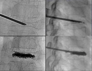 Tecniche radiologiche per il trattamento delle fratture ossee