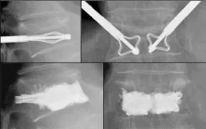 Paziente sottoposto a trattamento mini-invasivo per frattura con radiologia interventistica