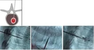 Strumenti per il trattamento di fratture con radiologia interventistica