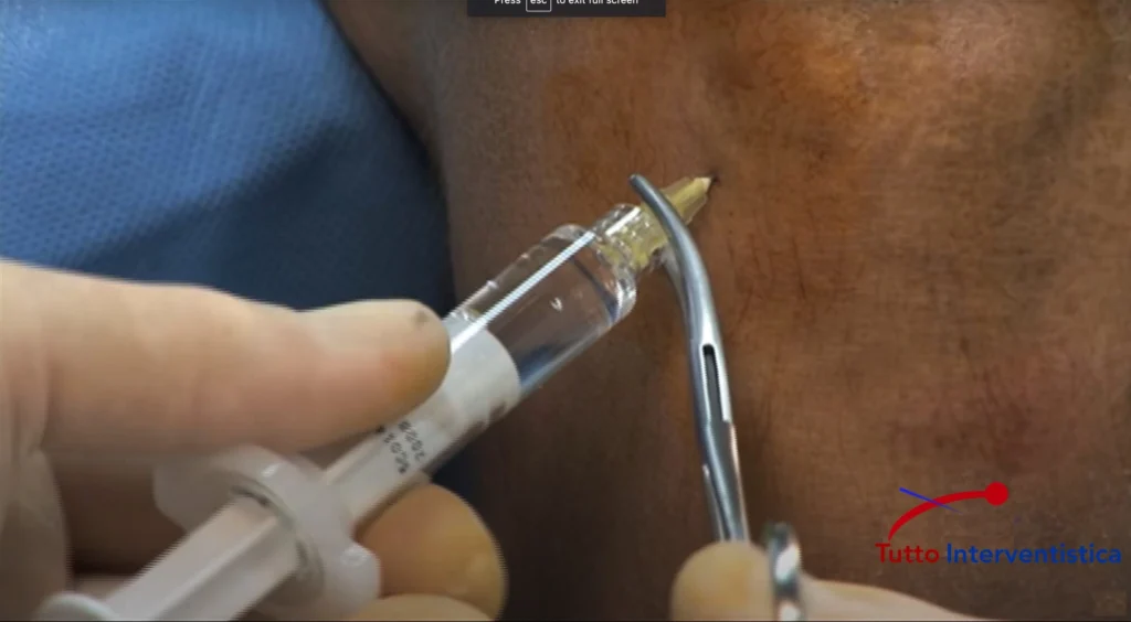 Iniezione di acido ialuronico nell'articolazione per migliorare la lubrificazione in caso di osteoartrosi.