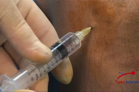 Iniezione di farmaco antinfiammatorio nell'articolazione per trattare l'osteoartrosi.