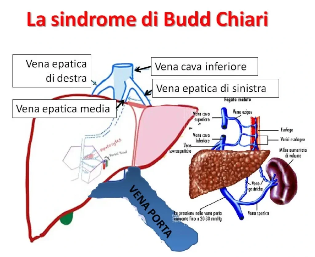 Catetere per trombolisi nelle vene sovraepatiche nella Sindrome di Budd-Chiari