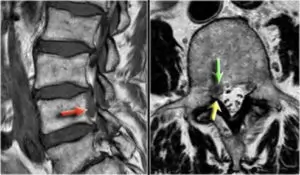 Severa ernia discale espulsa che comprime le strutture nervose del canale vertebrale