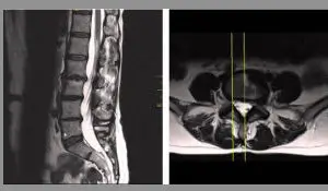 Ernia discale postero-laterale sinistra contenuta che comprime la radice nervosa di L2