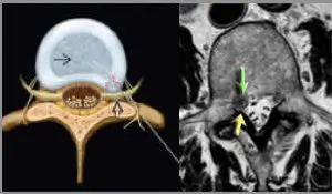 Ago da nucleoplastica durante l'inserimento nel disco lombare e visualizzazione tramite raggi X