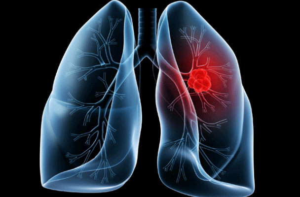 Cos'è il tumore del polmone, comprensione delle diverse forme come il carcinoma non a piccole cellule e il carcinoma a piccole cellule