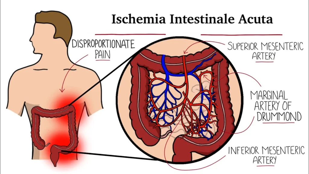 Trattamento di ischemia intestinale acuta con radiologia interventistica