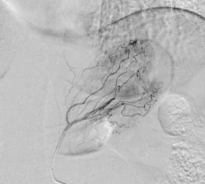 Paziente in fase di recupero dopo l'embolizzazione dell'arteria gastrica sinistra