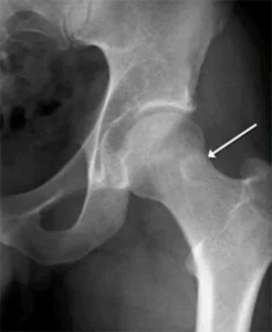 Ablazione con Radiofrequenza (RFA) - Procedura per Osteoma Osteoide Procedura mini-invasiva di ablazione con radiofrequenza (RFA) per il trattamento dell'osteoma osteoide.