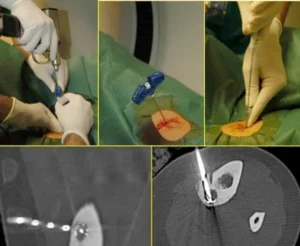 Radiofrequenza vs Chirurgia - Confronto dei Trattamenti per Osteoma Osteoide Confronto tra ablazione con radiofrequenza e chirurgia tradizionale nel trattamento dell’osteoma osteoide
