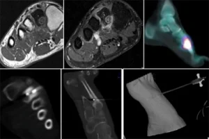 Recupero Post-Ablazione con Radiofrequenza - Benefici e Tempi di Guarigione Paziente in fase di recupero dopo ablazione con radiofrequenza per osteoma osteoide.