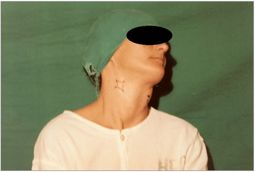 Embolizzazione del Tumore del Glomo Carotideo Procedura di embolizzazione per ridurre la vascolarizzazione di un tumore del glomo carotideo.