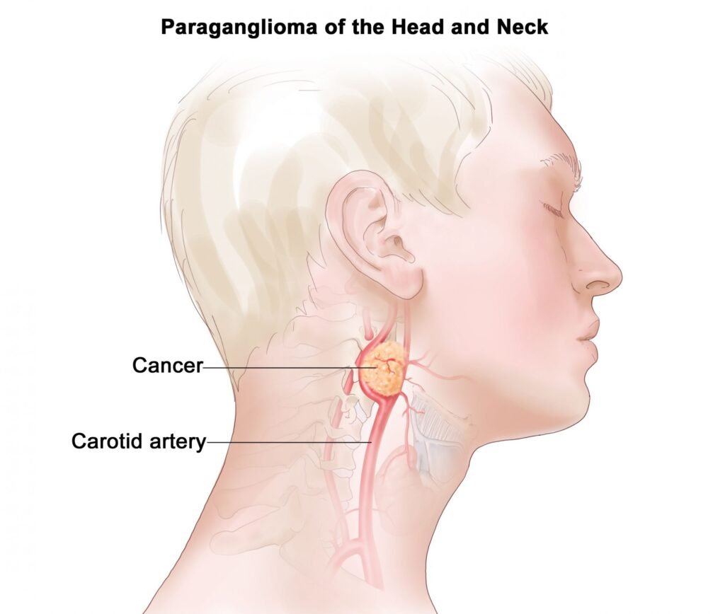 Tumore del Glomo Carotideo - Esame Arteriografico Immagine di un tumore del glomo carotideo evidenziato con arteriografia