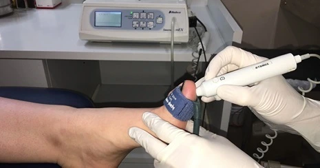 Trattamento di angioplastica per riaprire arterie occluse nel piede diabetico