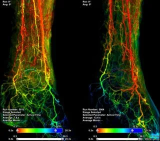 Calzature da medicazione per piede diabetico con solette in scarico per ridurre la pressione.
