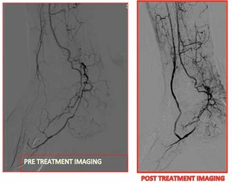 Procedura di angiografia per esaminare i vasi sanguigni compromessi nel piede diabetico
