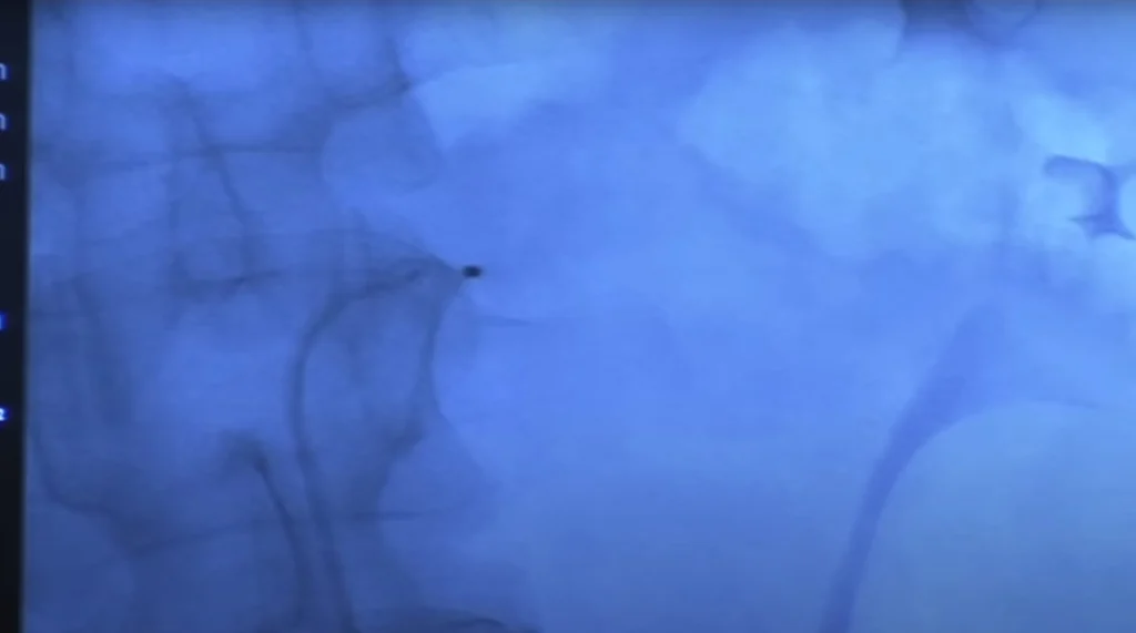 Catetere per Denervazione Renale – Trattamento Ipertensione Catetere utilizzato per la denervazione renale nella riduzione della pressione arteriosa