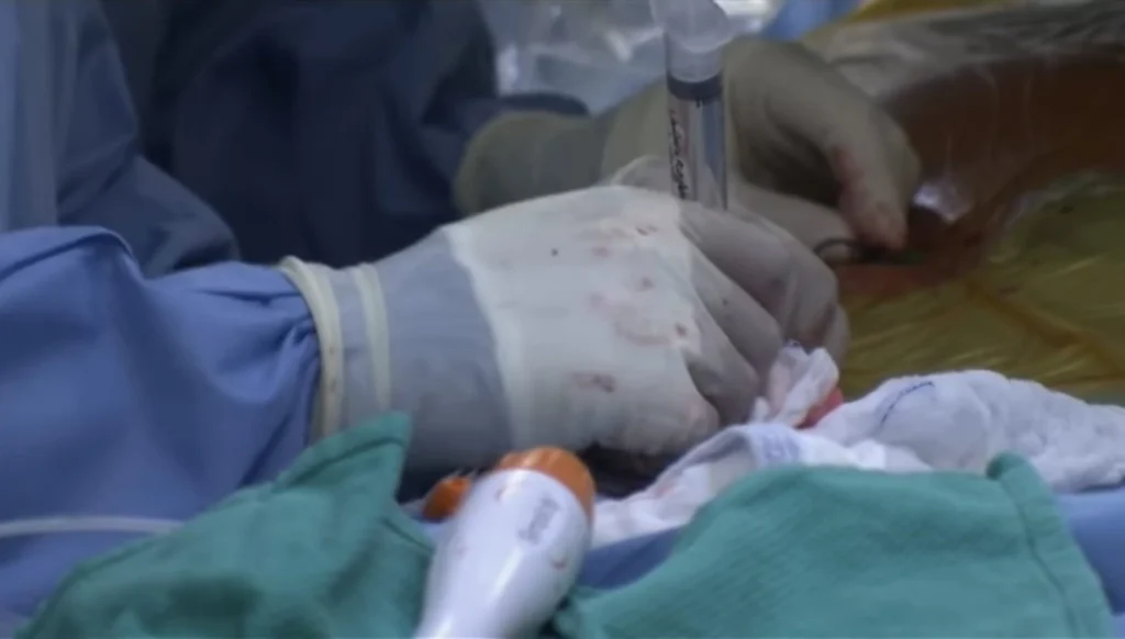 Risultati della Denervazione Renale – Efficacia nel Controllo della Pressione Riduzione della pressione arteriosa dopo la denervazione renale