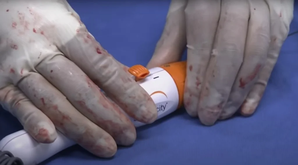 Denervazione Renale – Nuove Applicazioni Terapeutiche Nuove applicazioni della denervazione renale per diabete e scompenso cardiaco