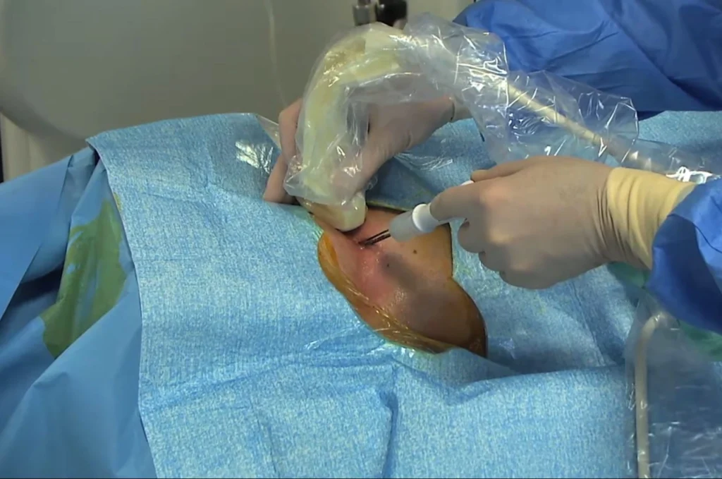 Radiologo esegue una procedura RFA sotto monitoraggio TAC