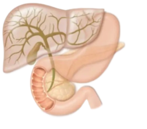 Drenaggio biliare per trattamento dei tumori delle vie biliari Drenaggio biliare per alleviare l'ostruzione delle vie biliari.