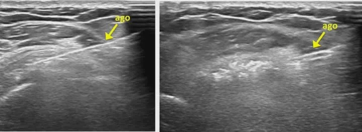 Ecografia che mostra il posizionamento degli aghi per il trattamento della tendinopatia calcifica.