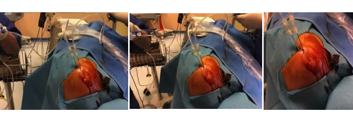 Posizionamento preciso degli aghi sotto guida ecografica per il trattamento della tendinopatia calcifica