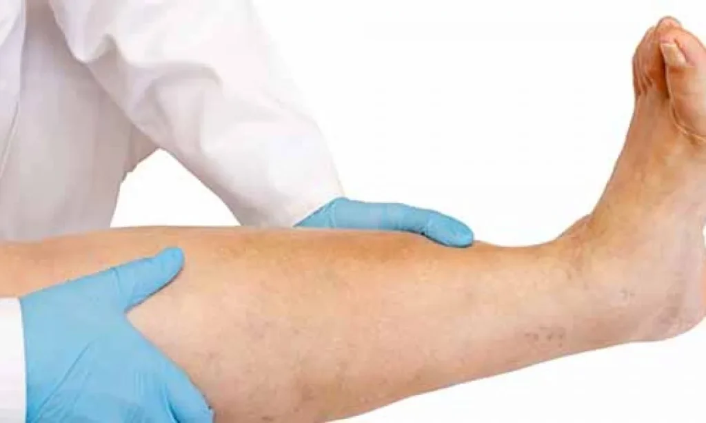 Immagine che mostra una sezione di una vena con un coagulo di sangue, simbolo della trombosi venosa profonda (TVP)